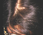 greffe-de-cheveux-femme-4