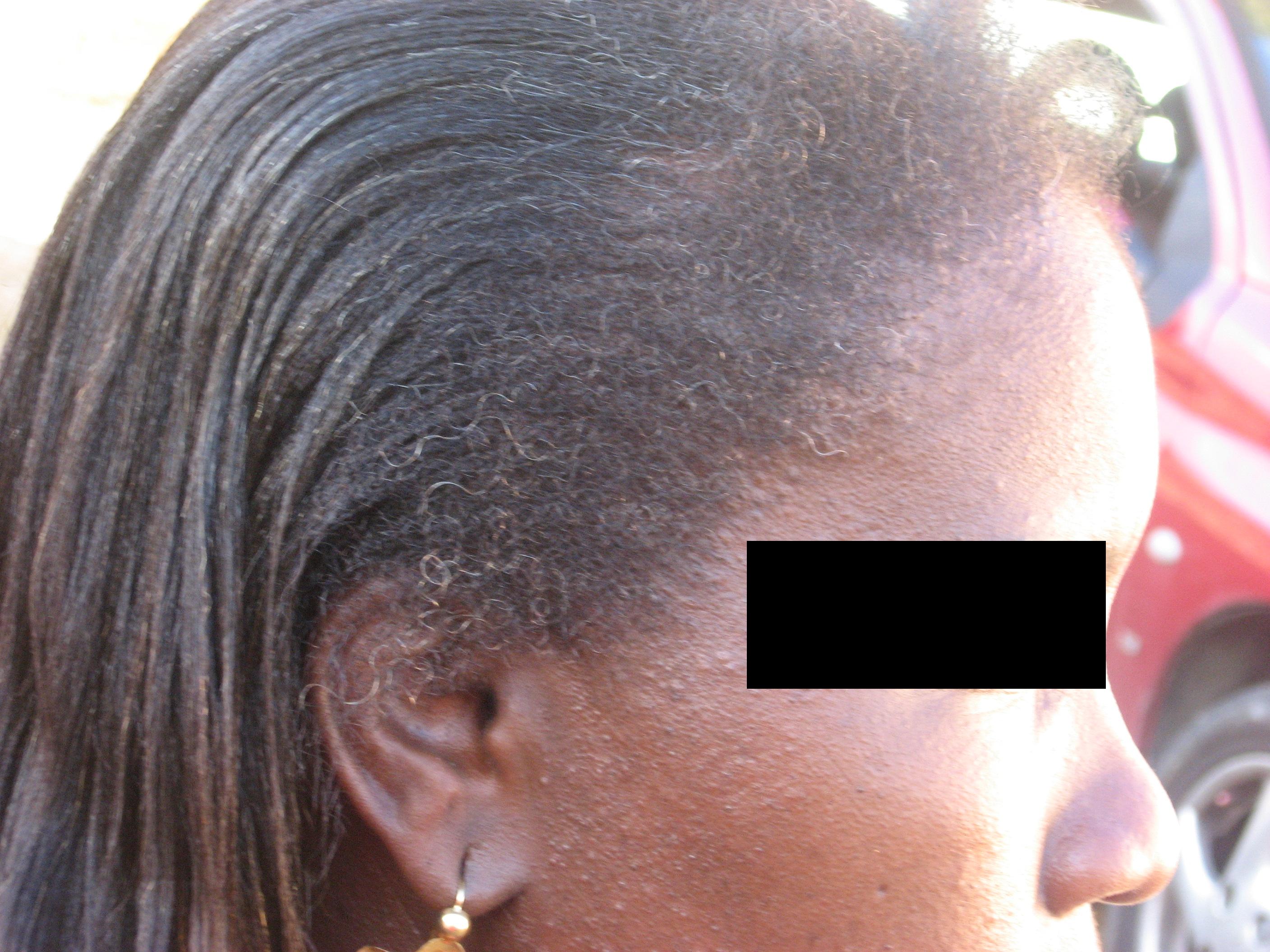 témoignage temoignage greffe cheveux implant chirurgie