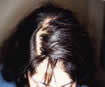 implantation cheveux